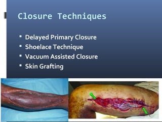 Closure Techniques
 Delayed Primary Closure
 Shoelace Technique
 Vacuum Assisted Closure
 Skin Grafting
 