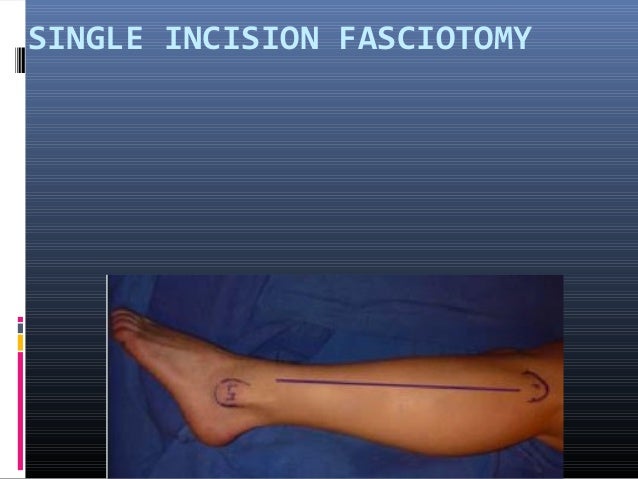fasciotomy of leg fasciotomy of leg
