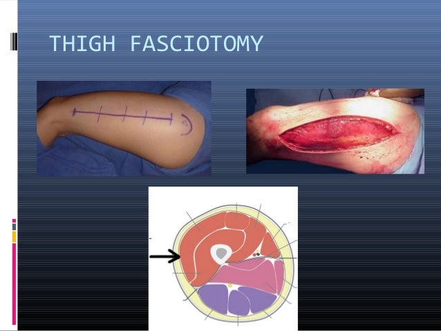 Fasciotomy