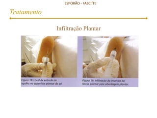 ESPORÃO - FASCIÍTE
Tratamento
Infiltração Plantar
 