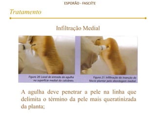 ESPORÃO - FASCIÍTE
Tratamento
Infiltração Medial
A agulha deve penetrar a pele na linha que
delimita o término da pele mais queratinizada
da planta;
www.traumatologiaeortopedia.com.b
r
 
