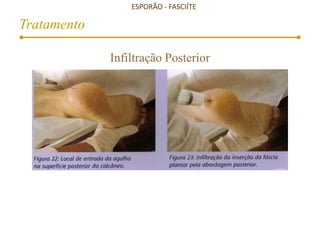 ESPORÃO - FASCIÍTE
Tratamento
Infiltração Posterior
 