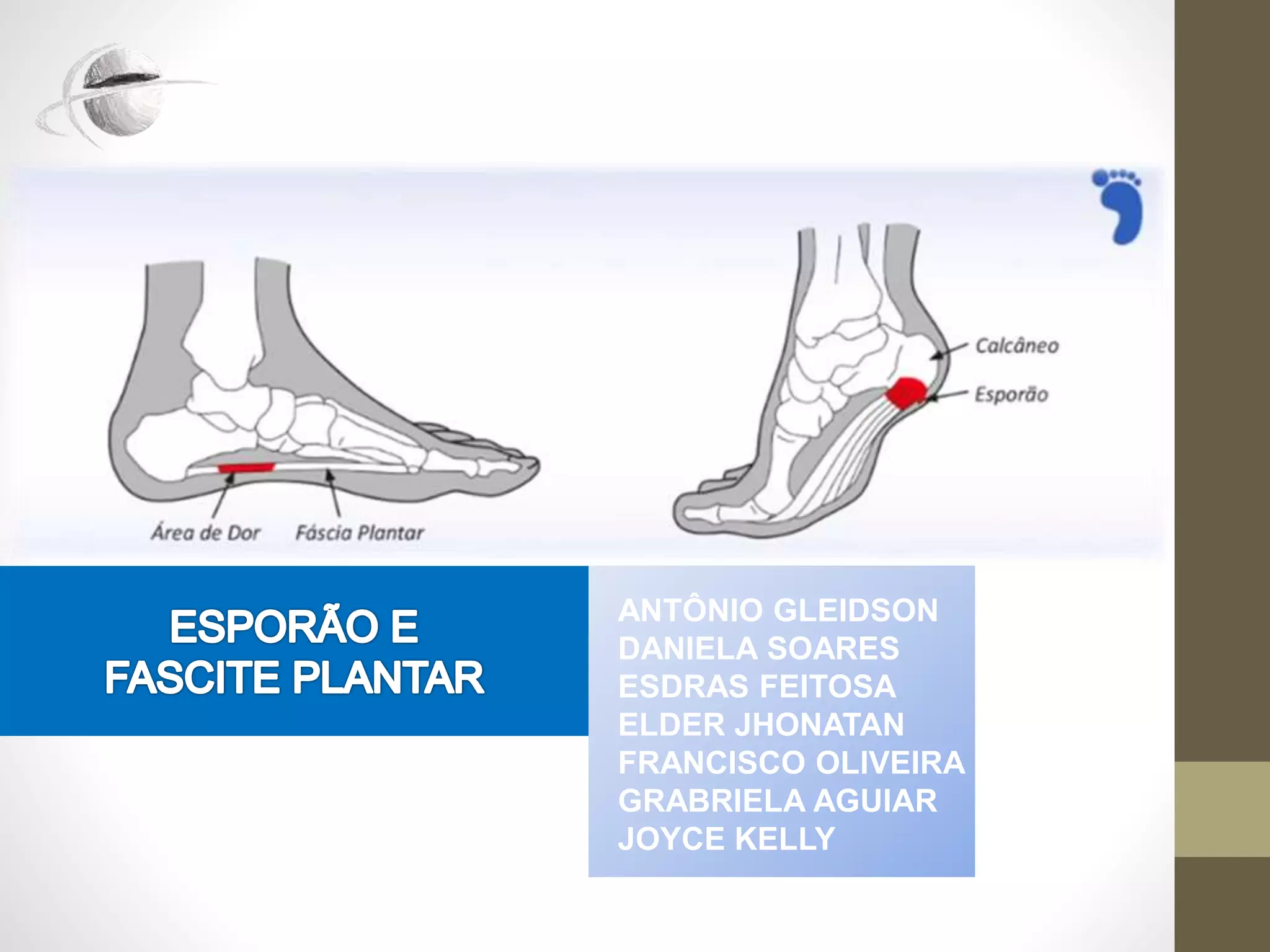 Fascite Plantar e Esporao | PPTX
