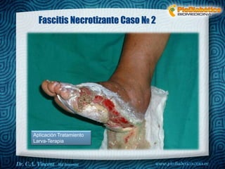 Dr. VINCENT, M.D 
Fascitis Necrotizante Caso № 2 
Aplicación Tratamiento 
Larva-Terapia 
 