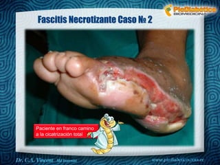 Dr. VINCENT, M.D 
Fascitis Necrotizante Caso № 2 
Paciente en franco camino 
a la cicatrización total 
 