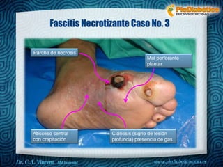 Fascitis Necrotizante Caso No. 3 
Mal perforante 
plantar 
Dr. VINCENT, M.D 
Parche de necrosis 
Cianosis (signo de lesión 
profunda) presencia de gas 
Absceso central 
con crepitación 
 