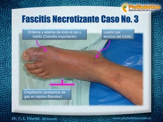 Fascitis Necrotizante Caso No. 3 
Eritema y edema de todo el pie y 
tobillo (Celulitis importante) 
Crepitación (presencia de 
gas en tejidos Blandos) 
Lesión por 
encima del tobillo 
 