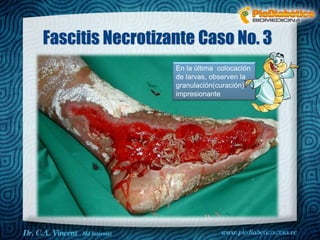 Fascitis Necrotizante Caso No. 3 
En la última colocación 
de larvas, observen la 
granulación(curación) 
impresionante 
Dr. VINCENT, M.D 
 
