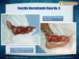 Fascitis Necrotizante Caso No. 3 
Aquí vemos como llego 
el paciente 
Dr. VINCENT, M.D 
Luego del tratamiento se 
ve notablemente la mejoría 
 