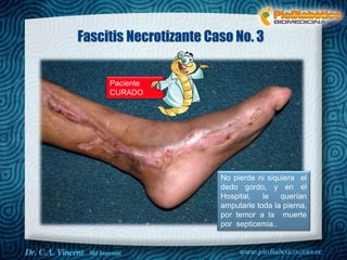 Fascitis Necrotizante Caso No. 3 
No pierde ni siquiera el 
dedo gordo, y en el 
Hospital, le querían 
amputarle toda la pierna, 
por temor a la muerte 
por septicemia.. 
Dr. VINCENT, M.D 
Paciente 
CURADO 

