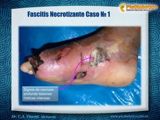 Dr. VINCENT, M.D 
Fascitis Necrotizante Caso № 1 
Signos de necrosis 
profunda lesiones 
hísticas intensas 
 