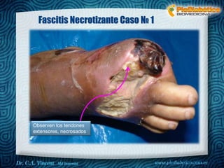 Dr. VINCENT, M.D 
Fascitis Necrotizante Caso № 1 
Observen los tendones 
extensores, necrosados 
 