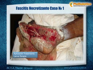 Dr. VINCENT, M.D 
Fascitis Necrotizante Caso № 1 
Aplicación Tratamiento 
Larva-Terapia 
 