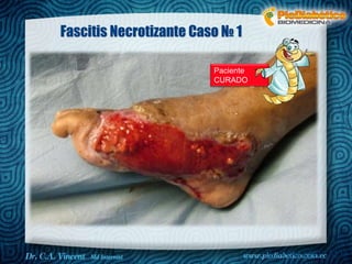 Dr. VINCENT, M.D 
Fascitis Necrotizante Caso № 1 
Paciente 
CURADO 
 