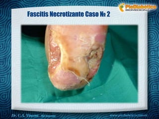 Dr. VINCENT, M.D 
Fascitis Necrotizante Caso № 2 
 