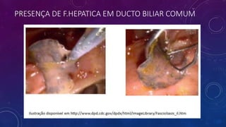 PRESENÇA DE F.HEPATICA EM DUCTO BILIAR COMUM
 
