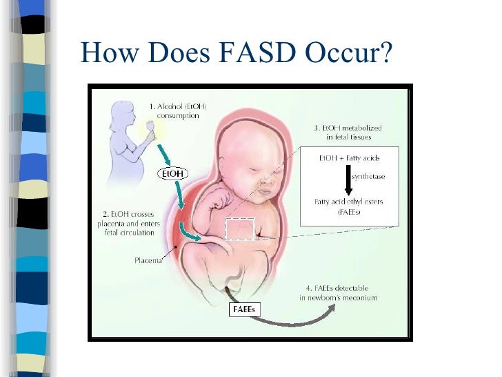 fetal alcohol spectrum disorder Learn about the symptoms and issues related to fetal alcohol spectrum disorder symptoms include problems with facial development. fetal alcohol spectrum disorder Learn about the symptoms and issues related to fetal alcohol spectrum disorder symptoms include problems with facial development.