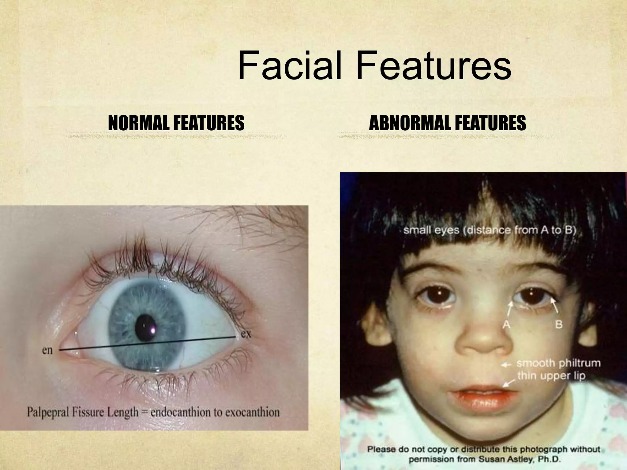 Fetal alcohol syndrome | PPTX