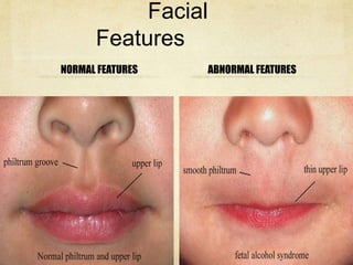 Fetal alcohol syndrome | PPTX