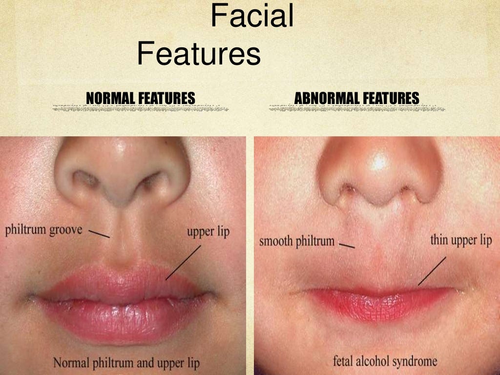 Fetal alcohol syndrome