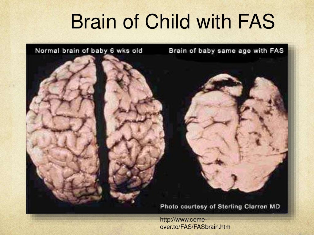 Fetal alcohol syndrome