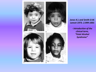 Jones K.L and Smith D.W.
Lancet 1973. 2.999-1001
- Introduction of the
clinical term,
“Fetal Alcohol
Syndrome”
 