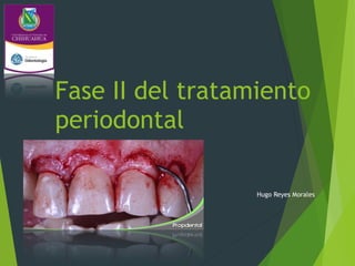 Fase II del tratamiento
periodontal
Hugo Reyes Morales
 