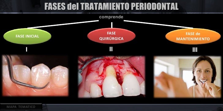 Fase 1 Y 2 De Tratamiento Periodontal