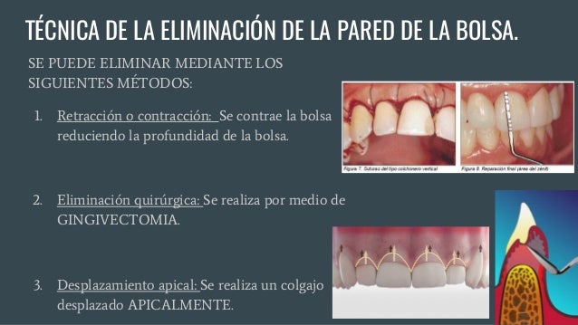 Fases Del Tratamiento Periodontal