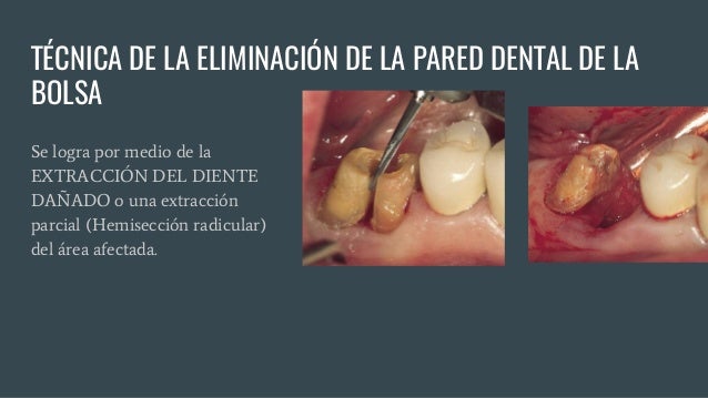 Fases Del Tratamiento Periodontal
