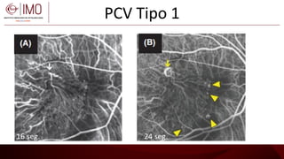 Angiografia Con Verde De Indocianina Fases Y Patrones En VCP angiografia-con-verde-de-indocianina-fases-y-patrones-en-vcp