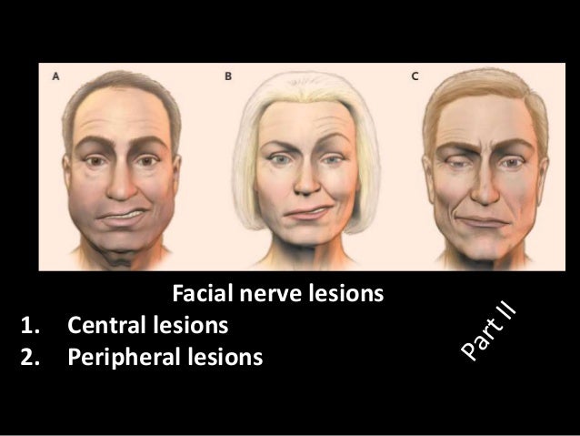 Yasmine recommends Central lesion of facial nerve Roscigno recommends Chinese girl gets fucked hard
