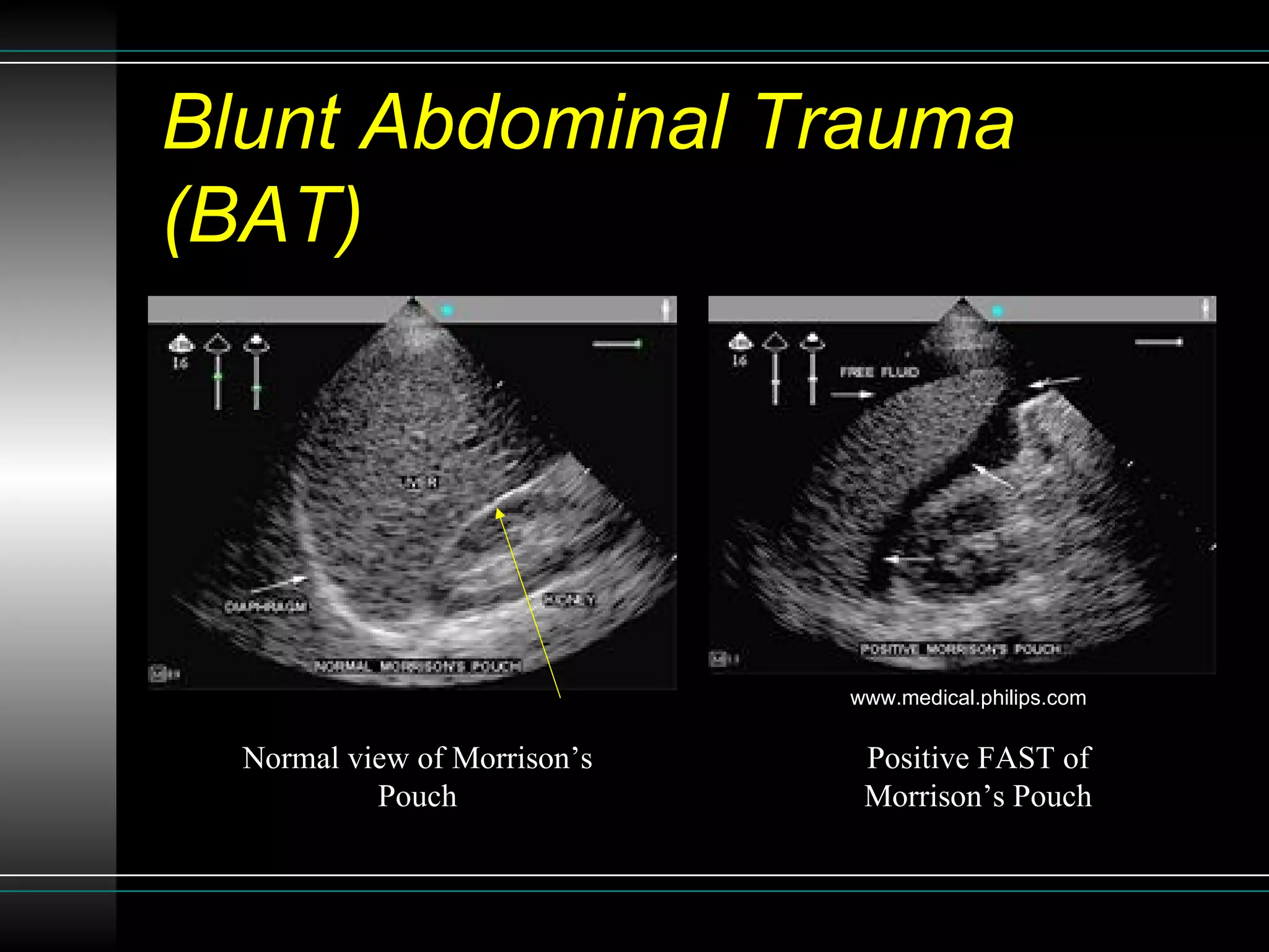 Sonographic Assessment of Blunt Abdominal Trauma in the Emergency ...