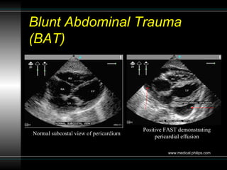 Sonographic Assessment of Blunt Abdominal Trauma in the Emergency ...