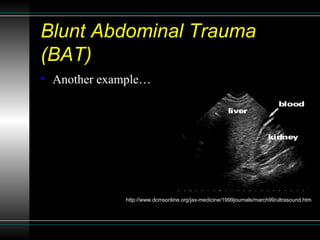 Blunt Abdominal Trauma (BAT) <ul><li>Another example… </li></ul>http://www.dcmsonline.org/jax-medicine/1999journals/march9...