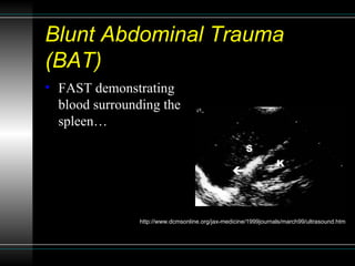 Blunt Abdominal Trauma (BAT) <ul><li>FAST demonstrating blood surrounding the spleen… </li></ul>http://www.dcmsonline.org/...