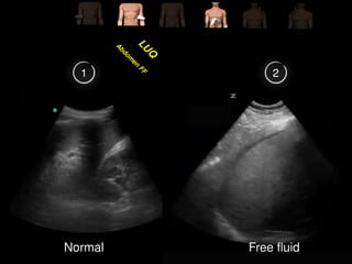 Comprehensive Guide to FAST & EFAST Ultrasound in Trauma Assessment | PPTX