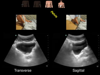 Comprehensive Guide to FAST & EFAST Ultrasound in Trauma Assessment | PPTX