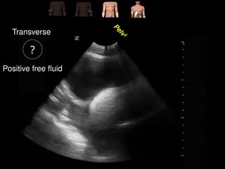 Comprehensive Guide to FAST & EFAST Ultrasound in Trauma Assessment | PPTX