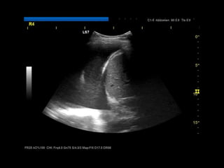Comprehensive Guide to FAST & EFAST Ultrasound in Trauma Assessment | PPTX