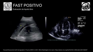 Fast Traumar FAST EFAST TRAUMA DE ORGANOS CERRADOS.pptx