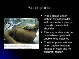 Paraxiphoid Fast exam2 | PPT