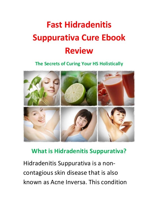 Holistically cure acne