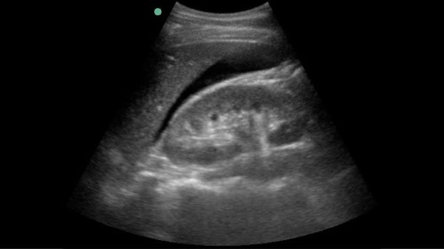 FAST scan in STABLE BLUNT TRAUMA patients