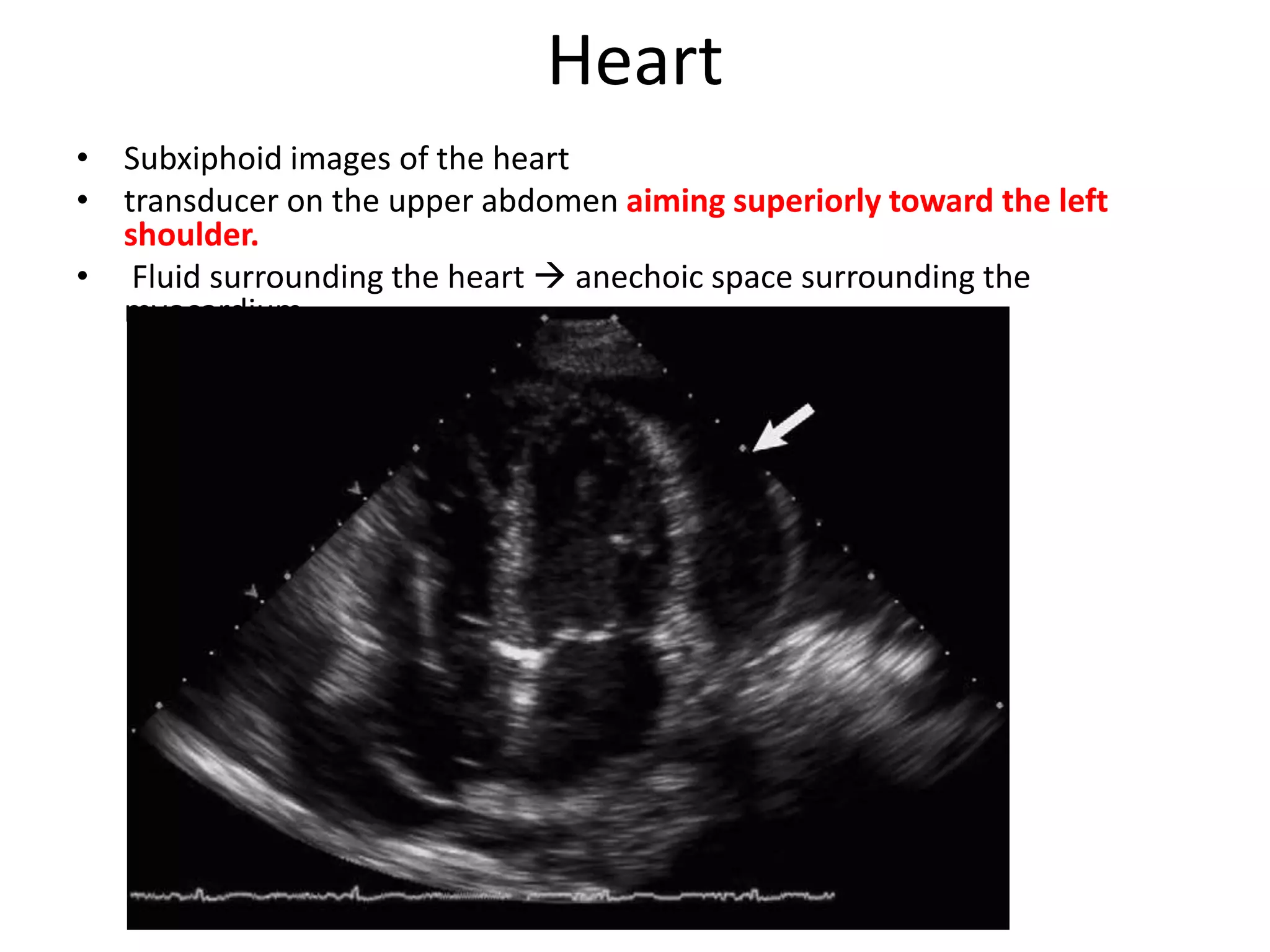 Heart
• Subxiphoid images of the heart
• transducer on the upper abdomen aiming superiorly toward the left
shoulder.
• Fluid surrounding the heart  anechoic space surrounding the
myocardium
 
