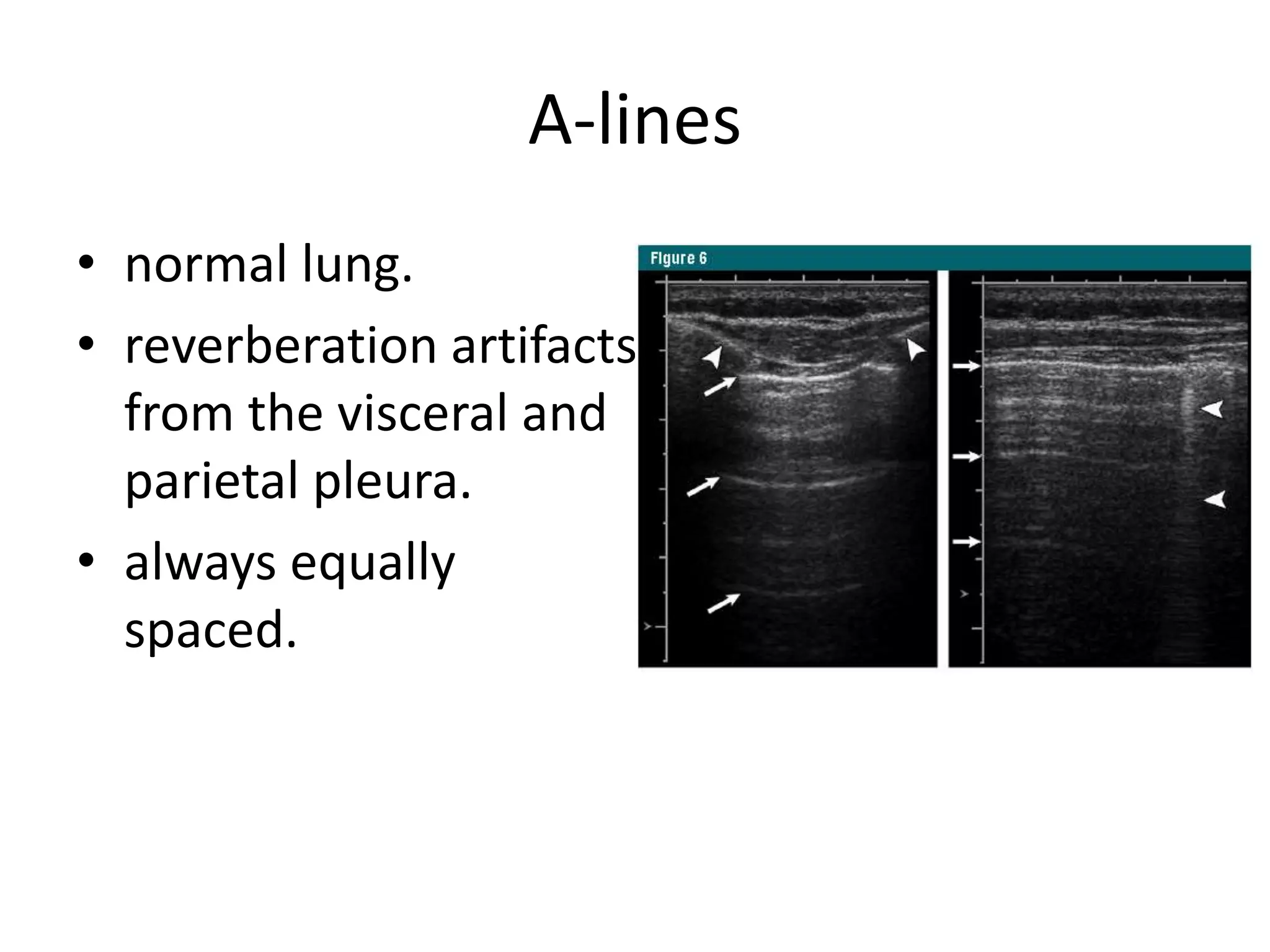 A-lines
• normal lung.
• reverberation artifacts
from the visceral and
parietal pleura.
• always equally
spaced.
 