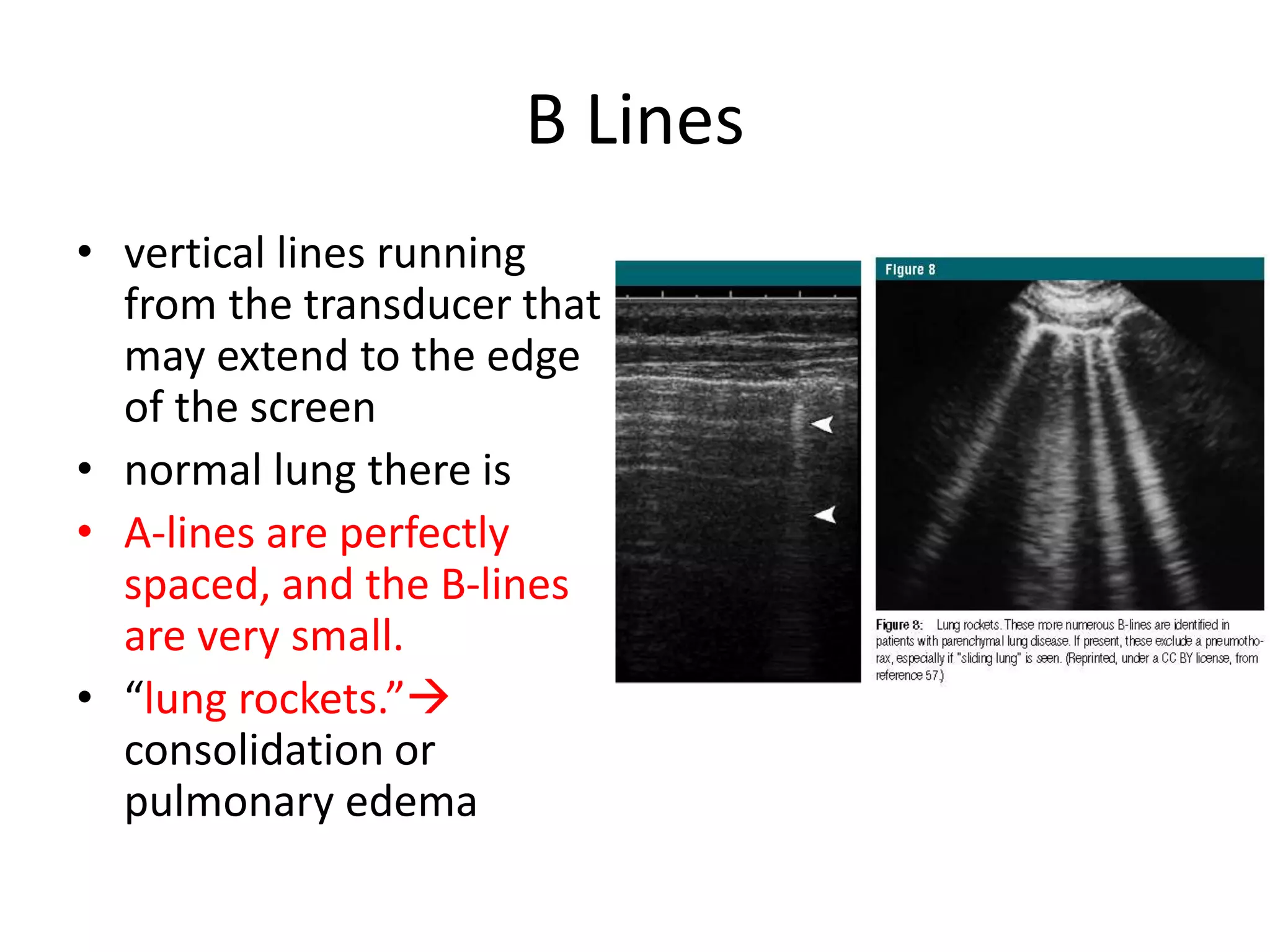 B Lines
• vertical lines running
from the transducer that
may extend to the edge
of the screen
• normal lung there is
• A-lines are perfectly
spaced, and the B-lines
are very small.
• “lung rockets.”
consolidation or
pulmonary edema
 