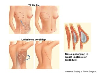 Fat Transfer with Adipose-derived Stem and Regenerative Cells for Breast Reconstruction