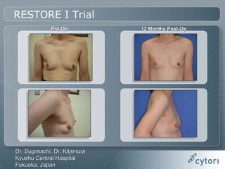 Fat Transfer with Adipose-derived Stem and Regenerative Cells for Breast Reconstruction