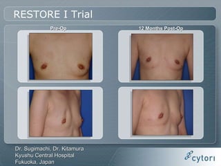 Fat Transfer with Adipose-derived Stem and Regenerative Cells for Breast Reconstruction